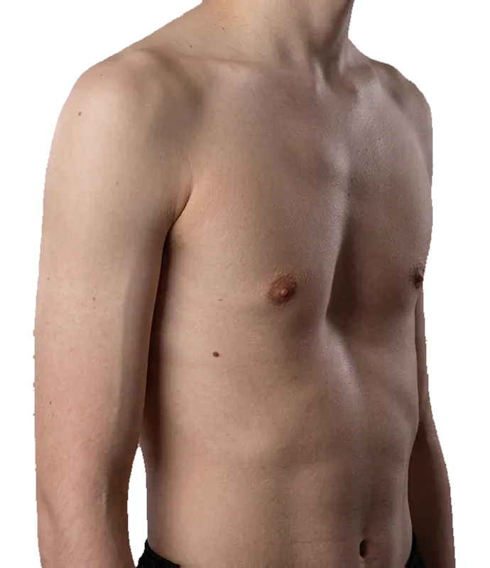 Pectus excavatum - a chest with the sternum sunken below the surrounding ribs