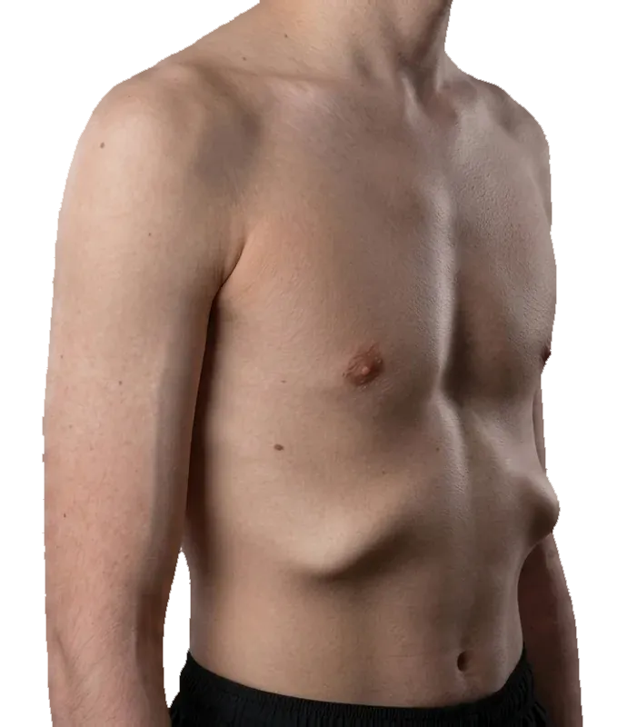 Rib flare - lower ribs angled outward and up instead of sitting flat