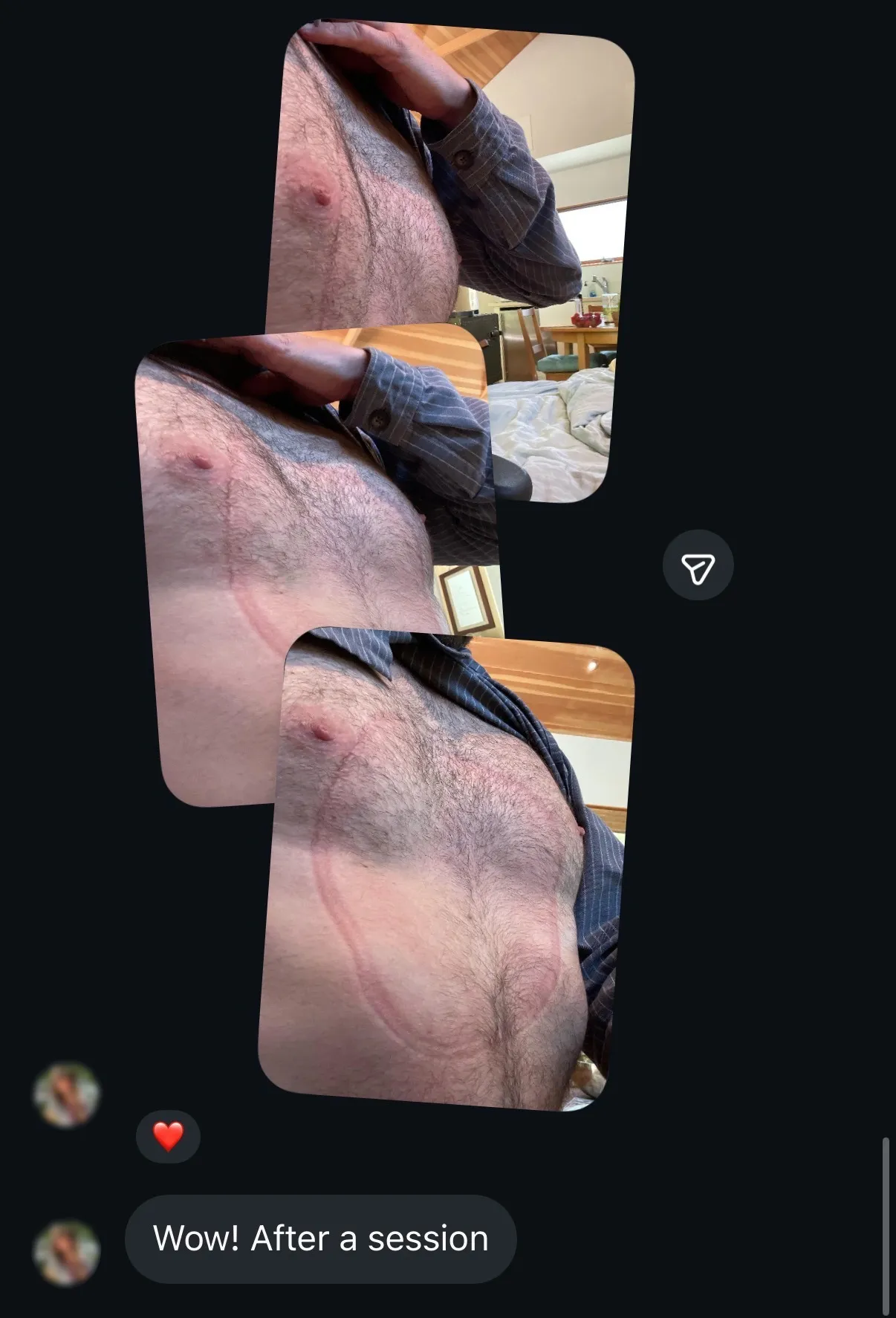 Instagram DM with chest photos showing improvement after a vacuum bell session
