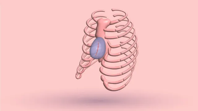 Pectus Excavatum Implants: 5 Types, Benefits & Cost
