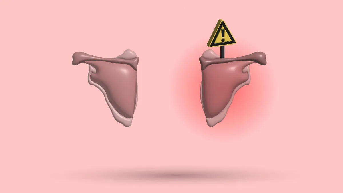 Pectus Excavatum And Winged Scapula: Essential: Guide