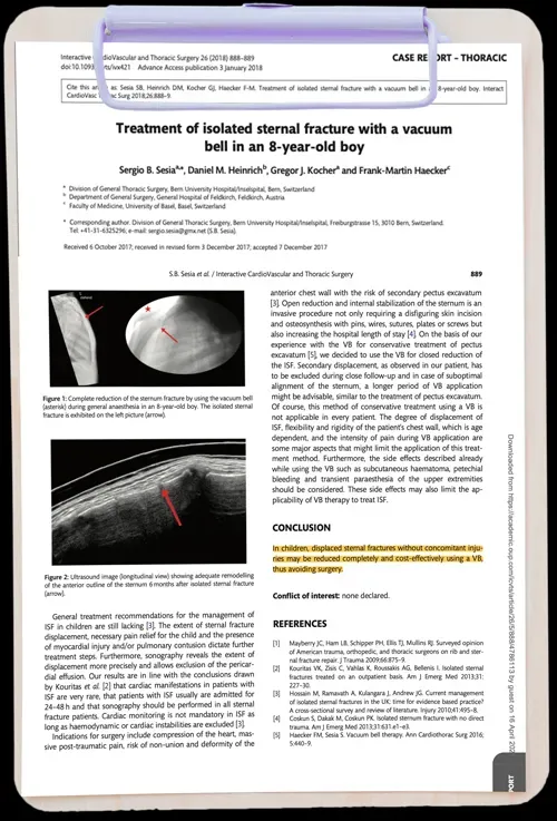 Treatment of isolated sternal fracture with a vacuum bell in an 8-year-old boy