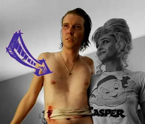 Alex cameron chest wall malformation