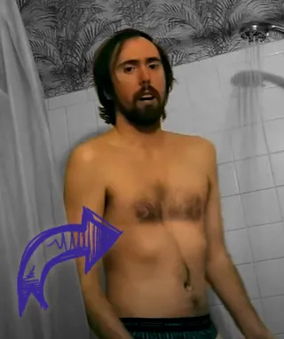 Asmongold pectus excavatum chest deformity