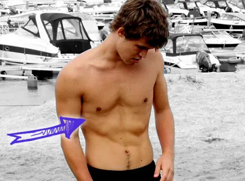 Magnus carlsen pectus excavatum deformity