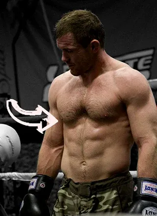 Matt hughes pectus excavatum chest