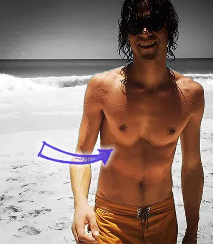 Miles mcmillan sunken chest deformity