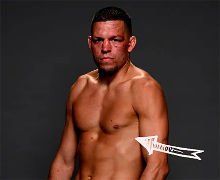Nate diaz pectus excavatum deformity