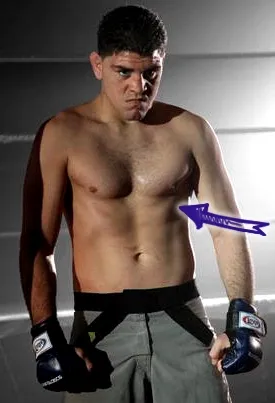 Nick diaz sunken chest deformity 1