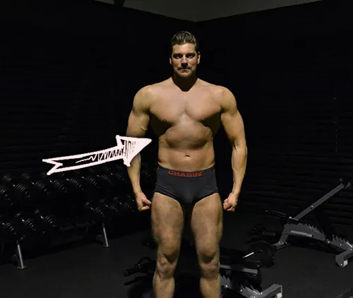 Olivier richters after sunken chest surgery