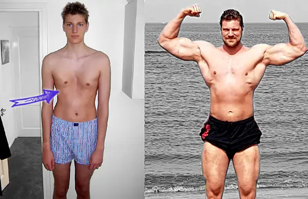 Olivier richters before pectus excavatum chest wall deformity