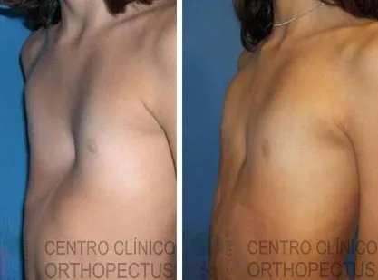 Orthopectus before and after pectus excavatum