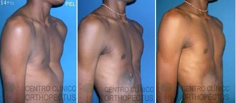 Orthopectus transfomartion flare ribs
