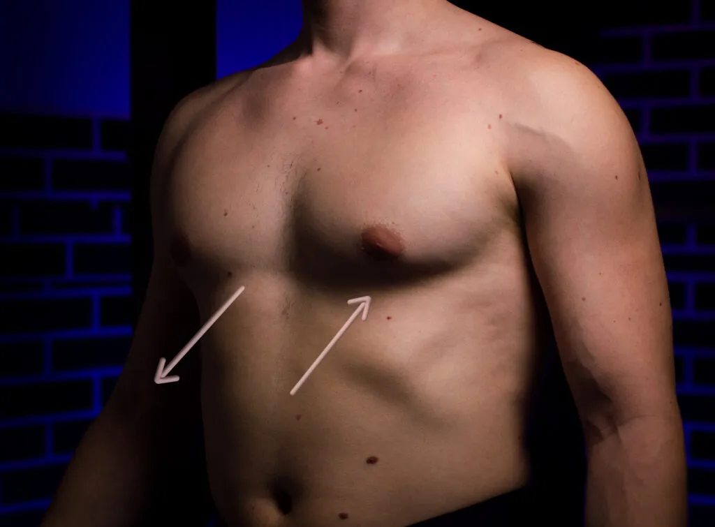 Asymmetric pectus excavatum vacuum bell sizing
