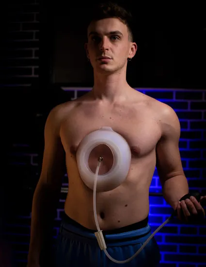Pectus healing vacuum bell