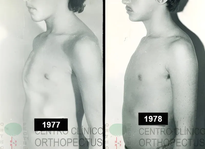 The first pectus patient treated with a custom compression brace