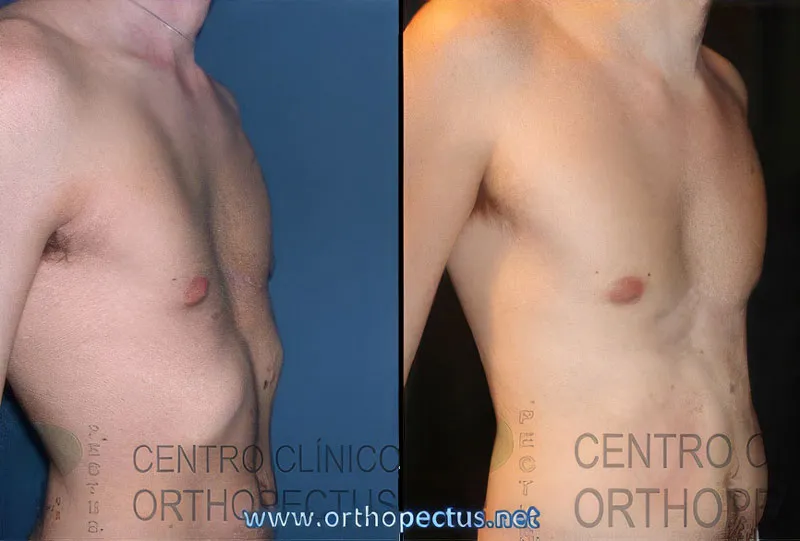 Pectus excavatum and rib flare before and after brace treatment