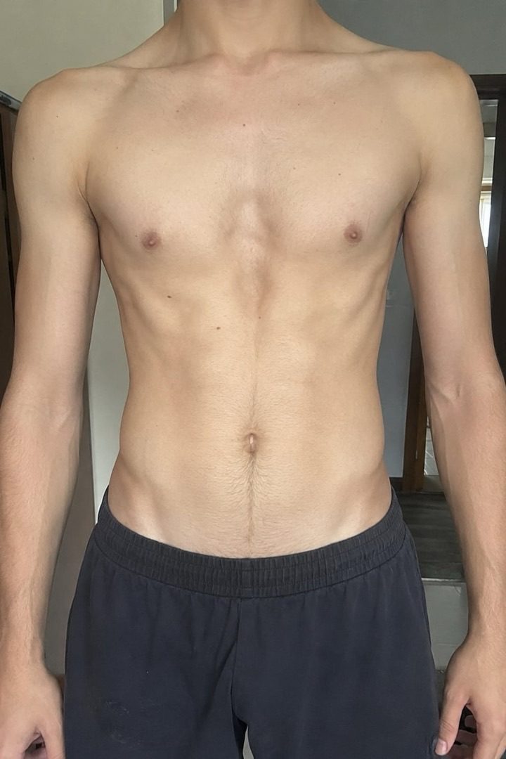 Andro — pectus excavatum chest before and after the plan