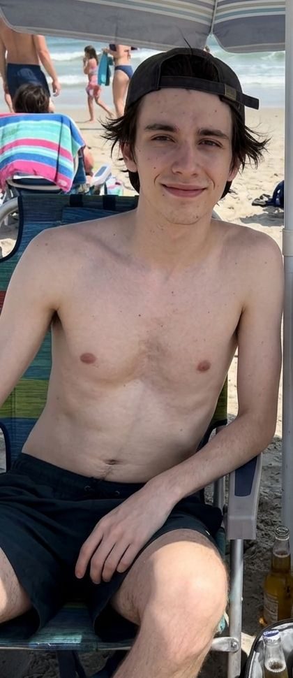 Ian — pectus excavatum and rib flare chest before and after the plan