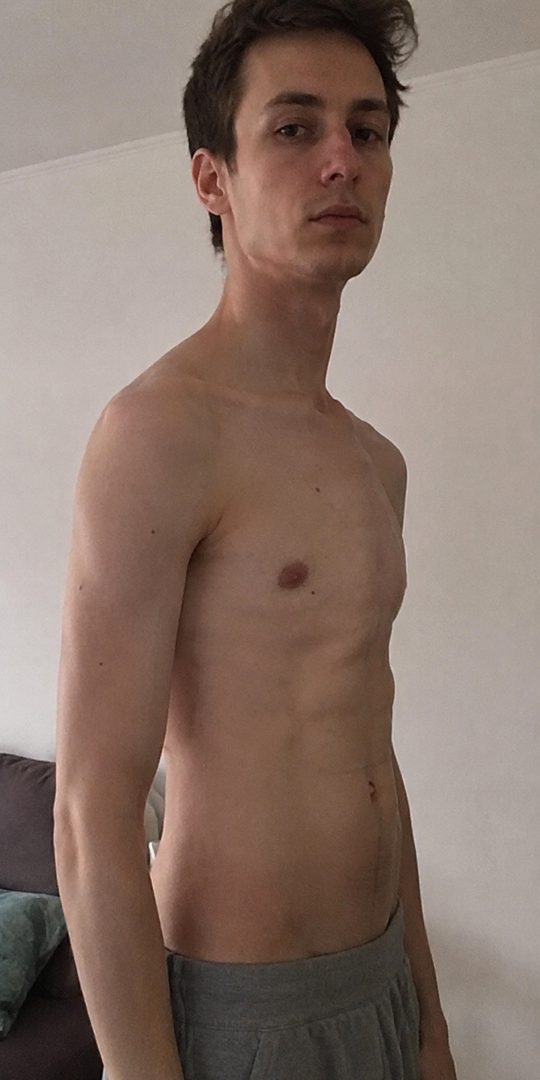 Beau — pectus carinatum chest, side profile, before and after 4 months of 1-on-1 coaching