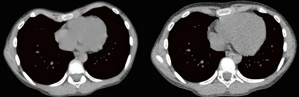 Patient 4, CT scans answering whether the vacuum bell works