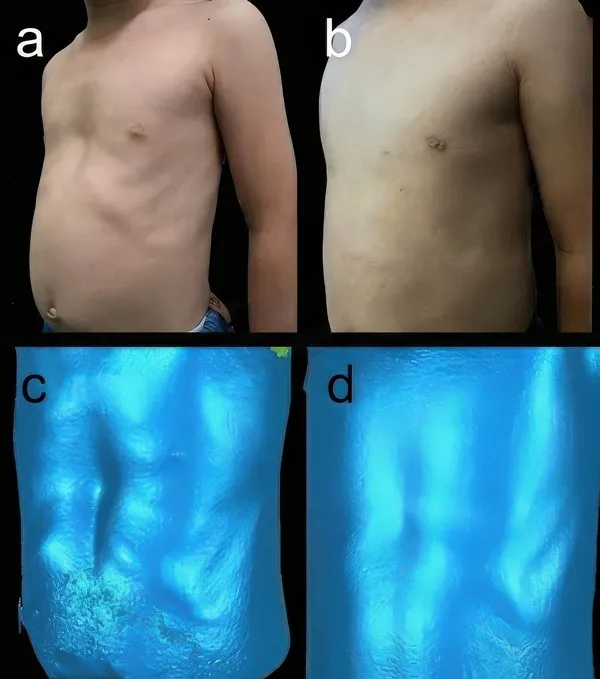 Patient 1, sunken chest before and after vacuum bell use, with 3D scan comparison